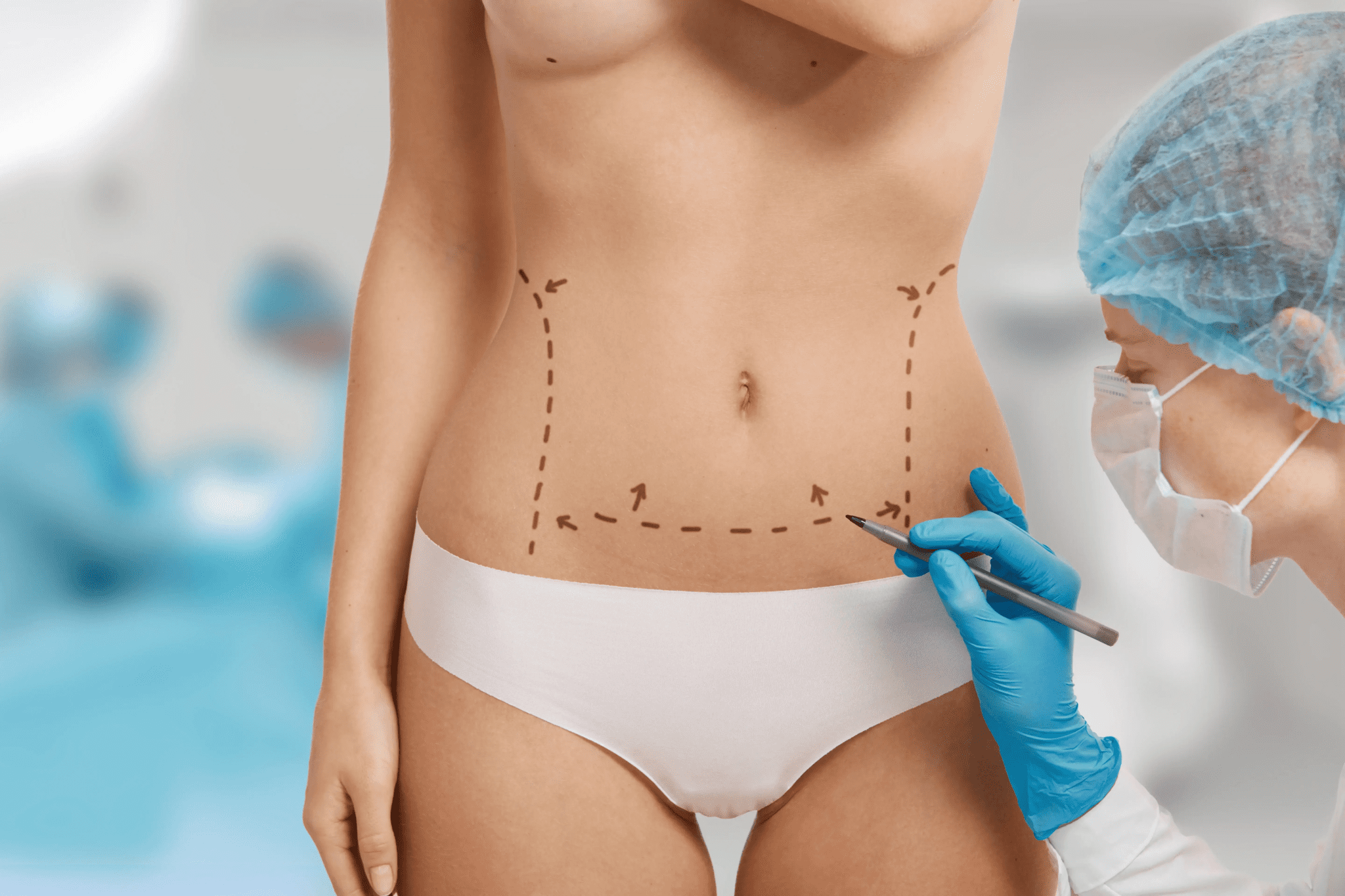 liposuccion en barcelona