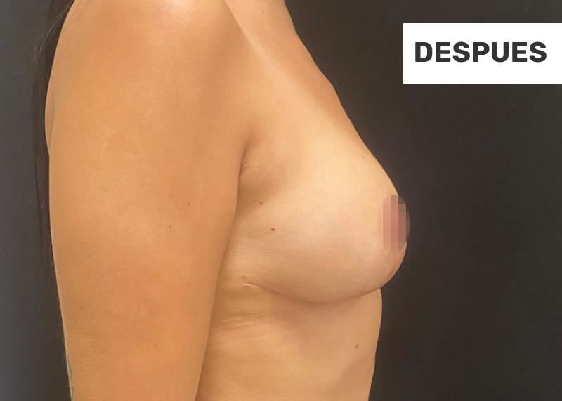 3-elevacion-mamas-despues