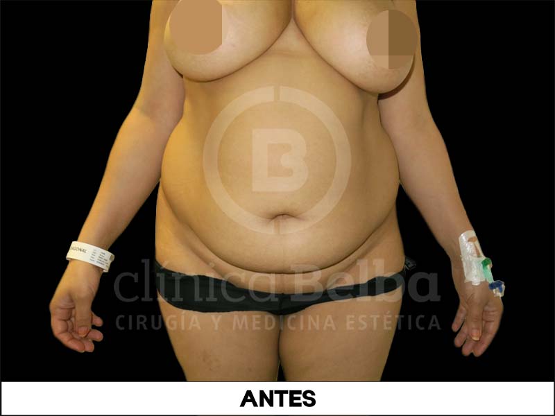 abdominoplastia fotos reales antes y despues