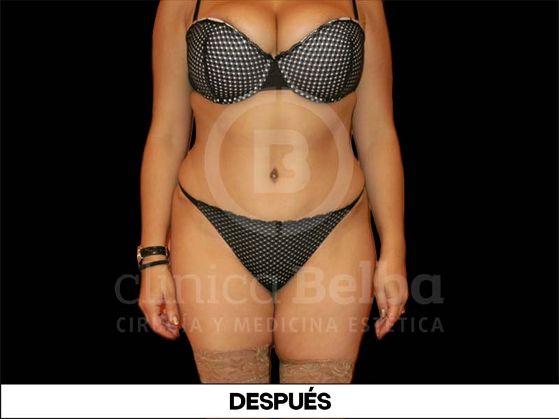 abdominoplastia fotos reales antes y despues