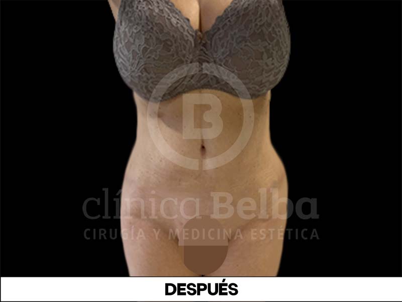Abdominoplastia Despues