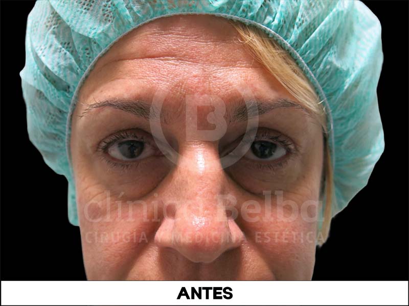 operación párpados caídos antes y después