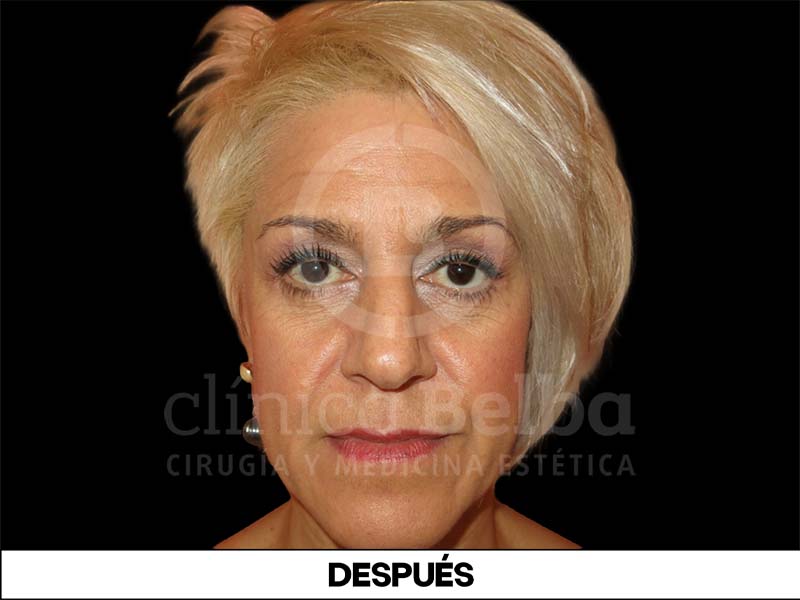 operación párpados caídos antes y después
