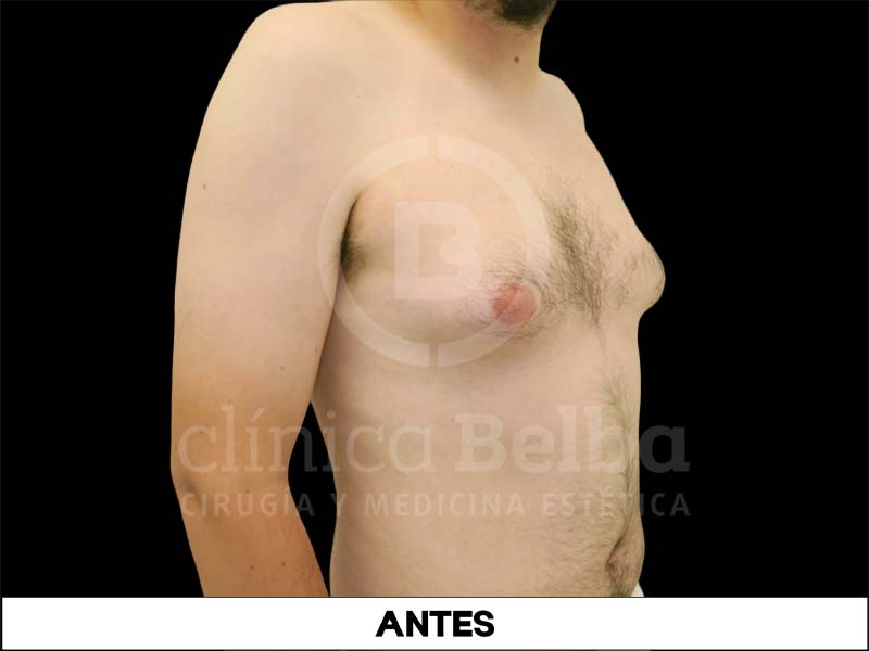 ginecomastia antes y despues