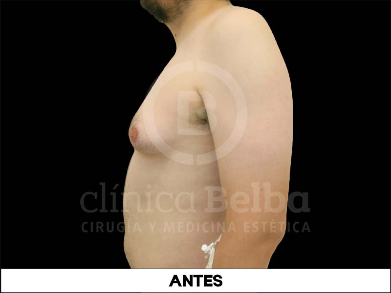 ginecomastia antes y despues