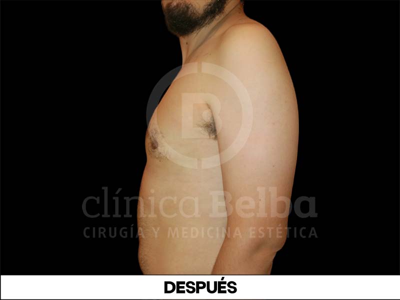 ginecomastia antes y despues