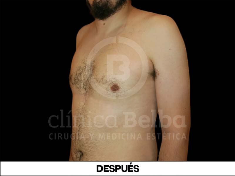 ginecomastia antes y despues