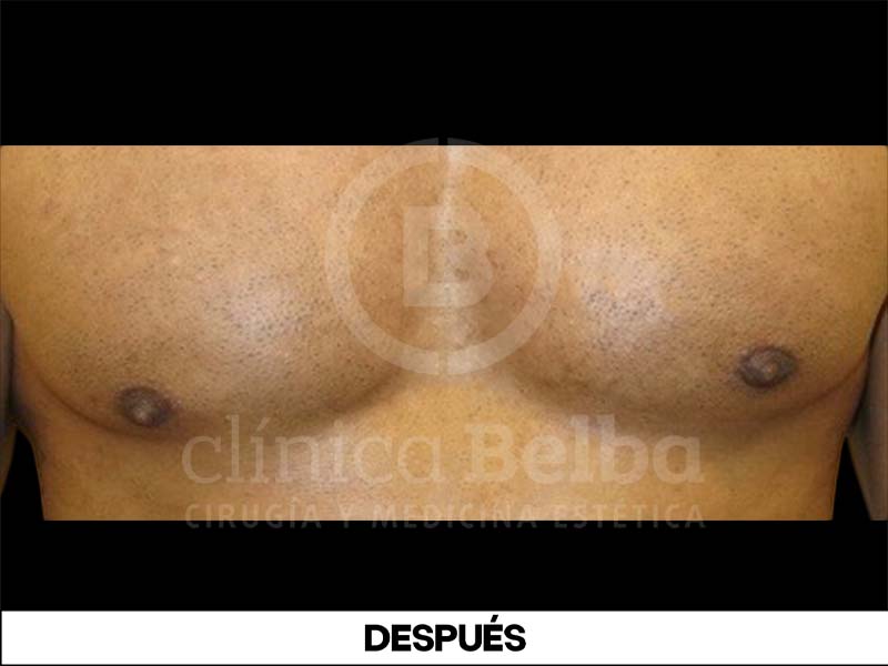 ginecomastia antes y despues