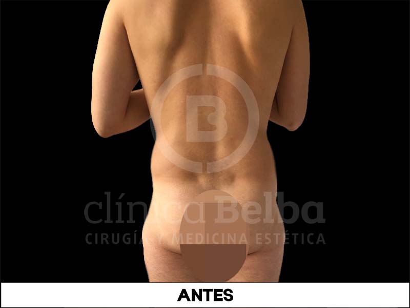 liposuccion antes y despues