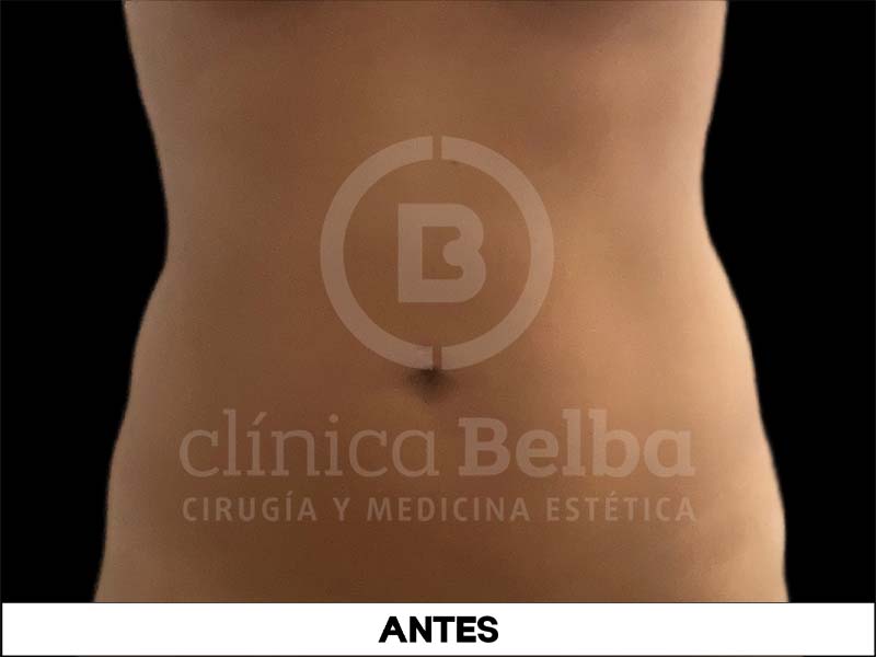 liposuccion antes y despues