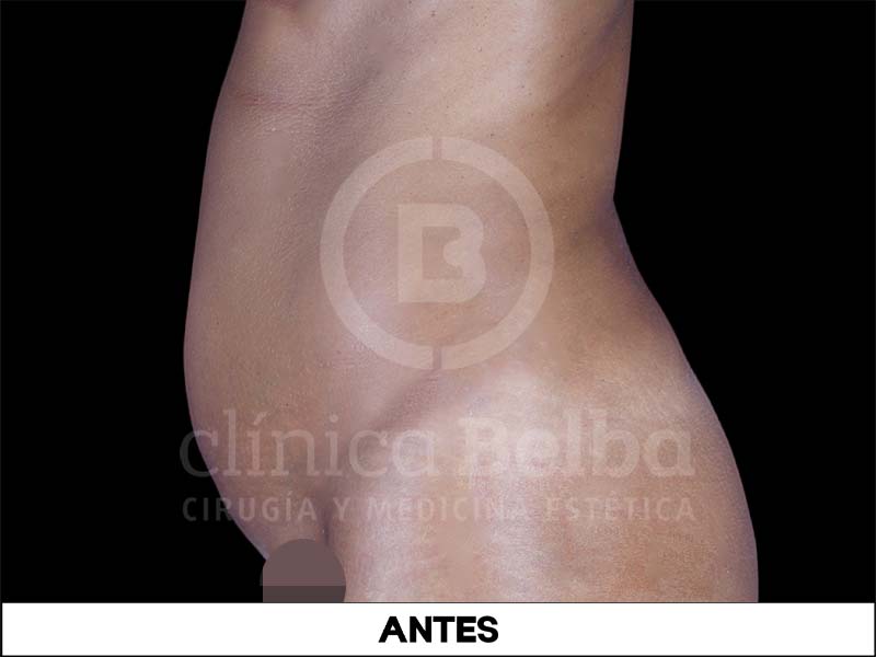 liposuccion antes y despues