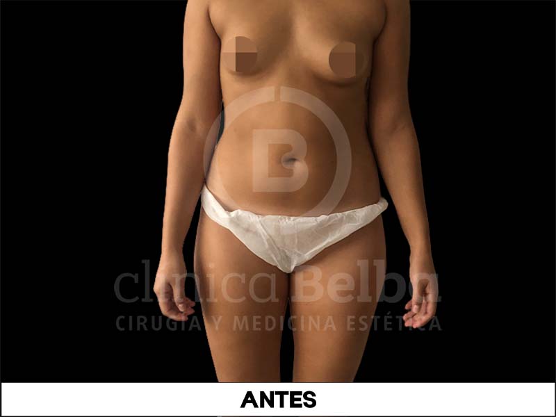 liposuccion abdomen antes y despues