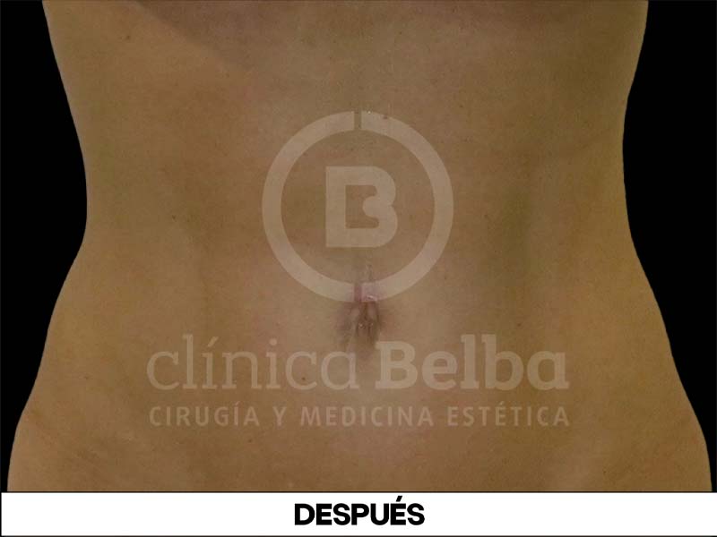 liposuccion antes y despues