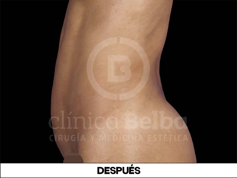liposuccion antes y despues