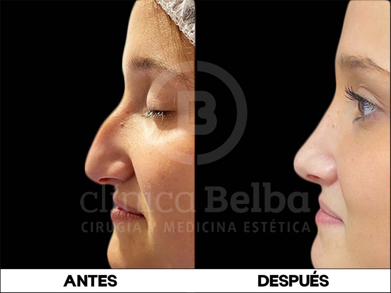 rinoplastia antes y después mujeres