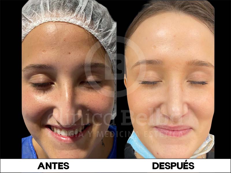 rinoplastia antes y después mujer