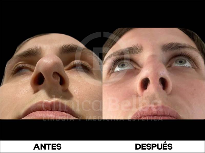 Rinoplastia Antes y Después Hombre