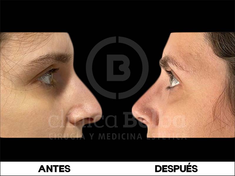 Rinoplastia Antes y Después Hombre
