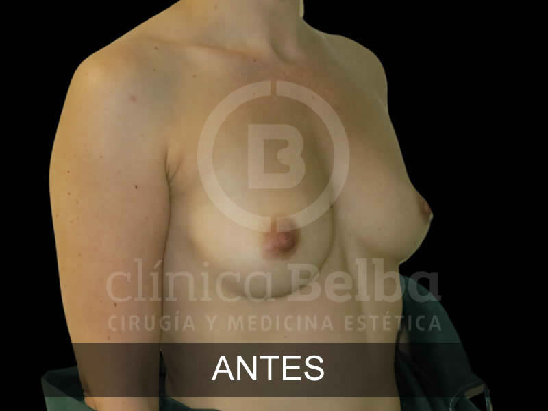 Aumento de Pecho Brst antes y después