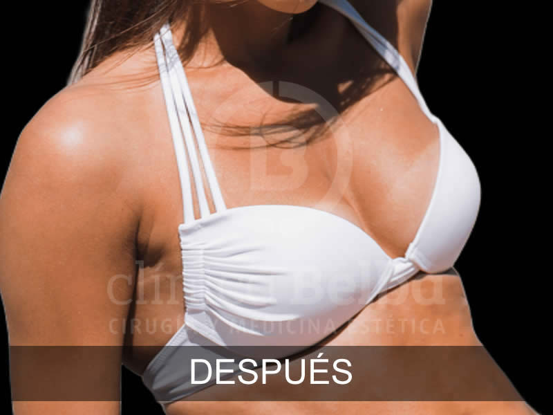 Aumento de Pecho Brst antes y después