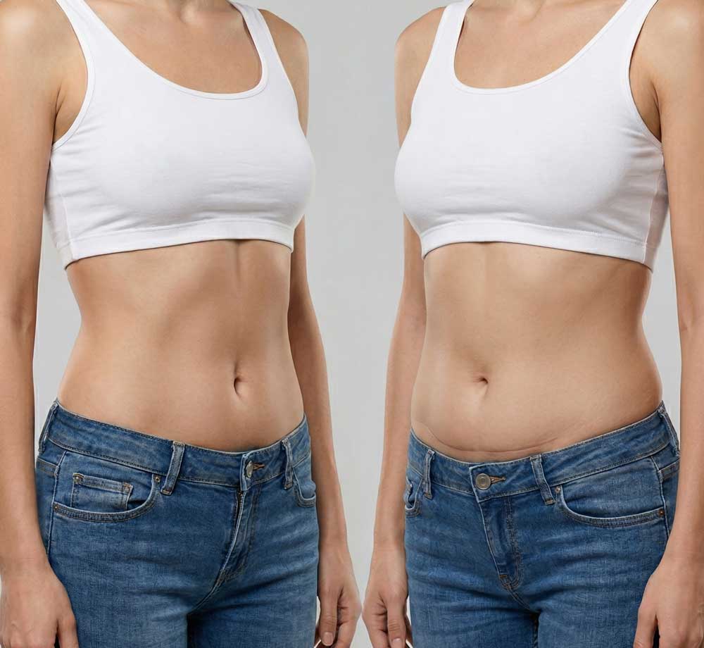 Abdominoplastia-o-liposucción-