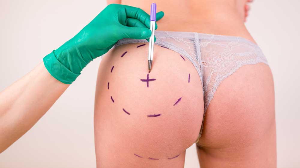 Brazilian-Butt-Lift