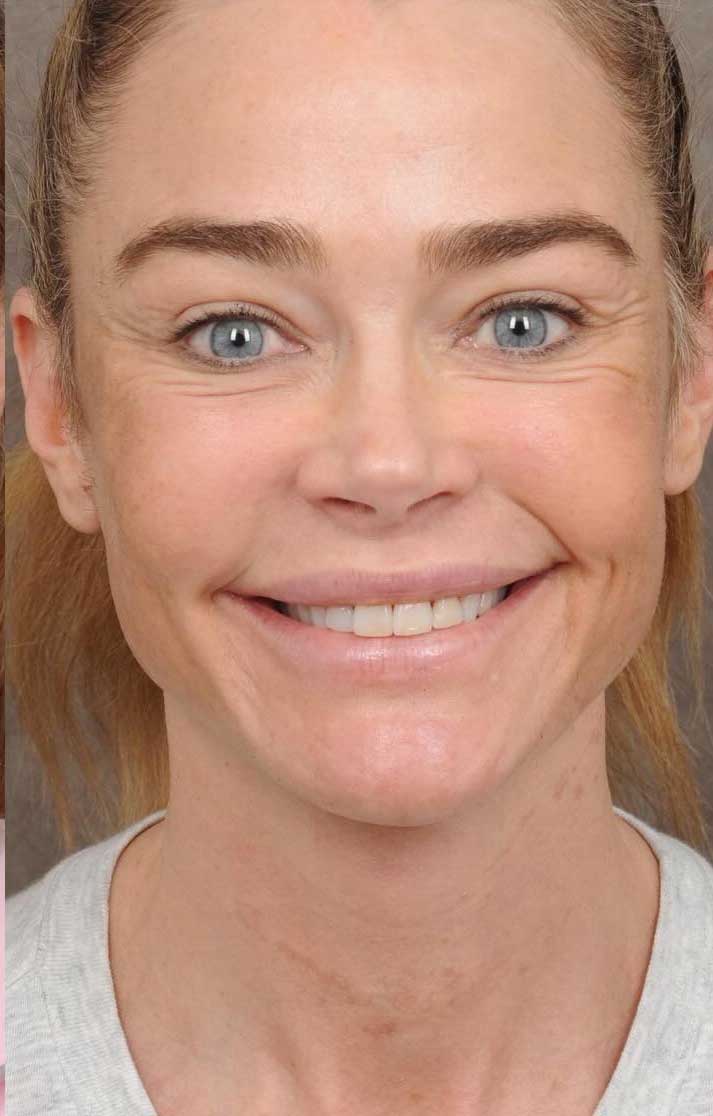 Denise-Richards-despues-facelift-