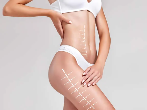 liposuccion precio