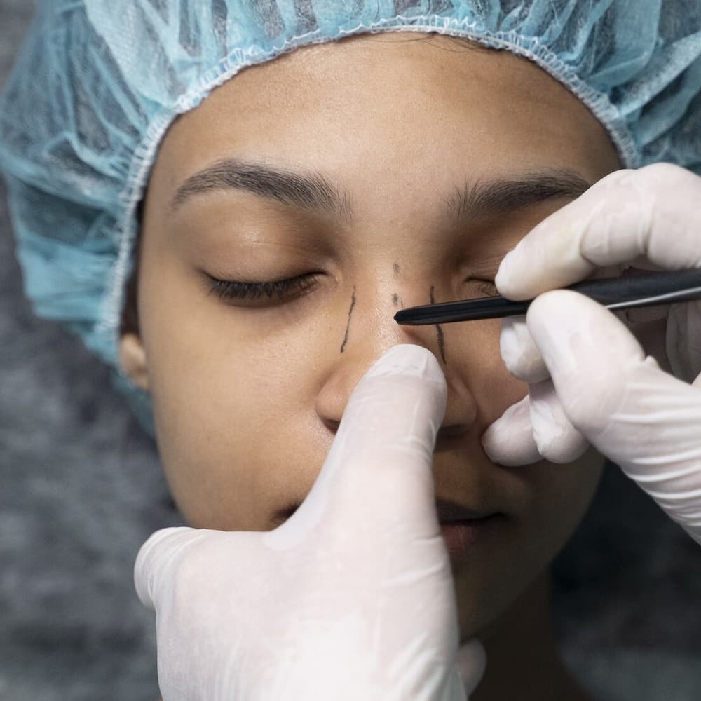 rinoplastia o rinomodelacion