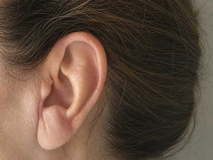 otoplastia-antes-y despues