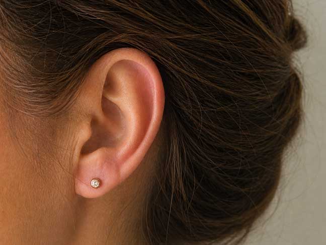 otoplastia-antes-y despues