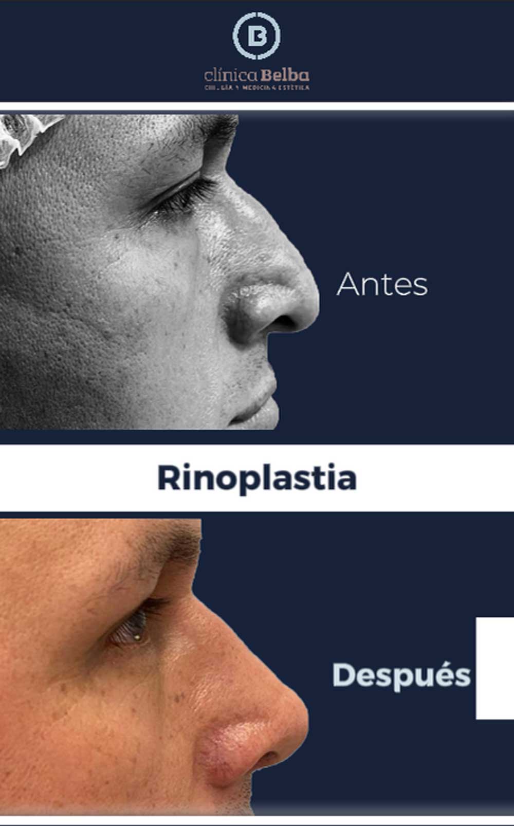 Antes-y-despues-rinoplastia
