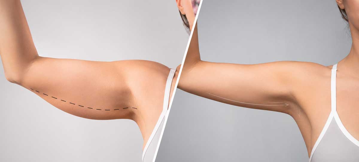 Braquioplastia o liposucción de brazos