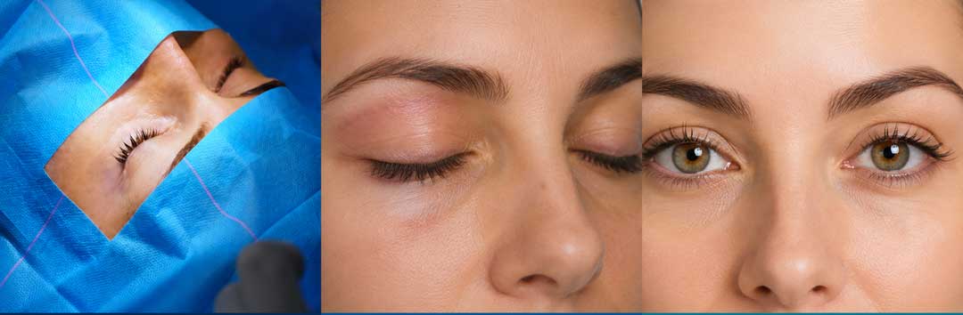 cuánto dura una blefaroplastia