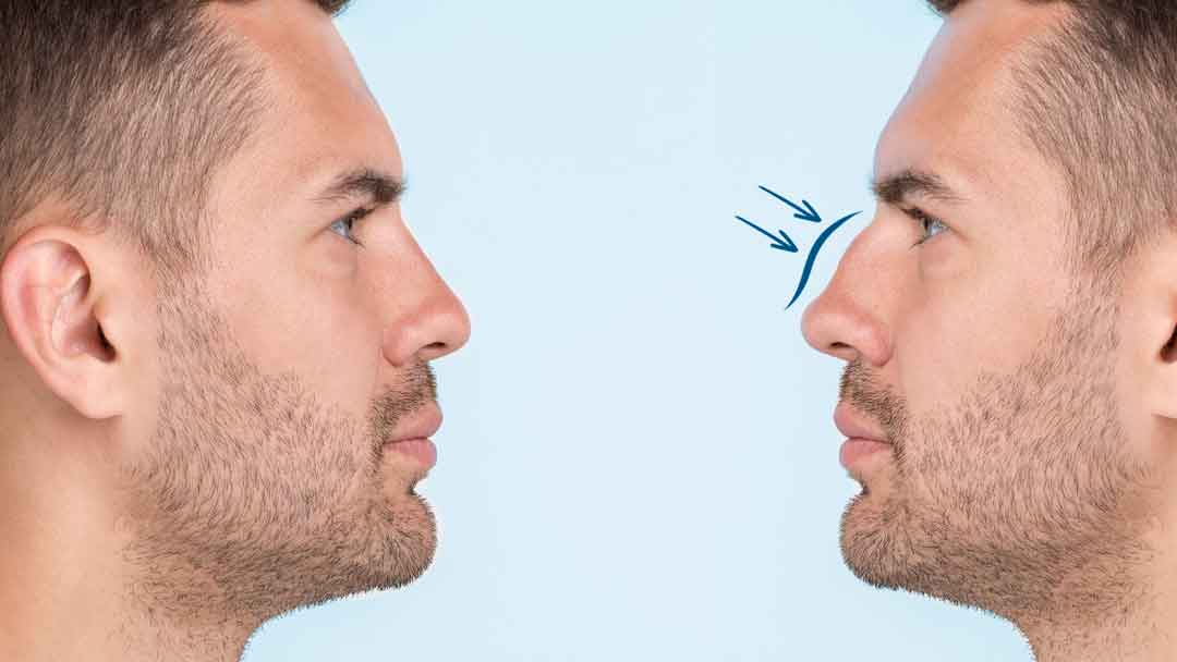 Rinoplastia-en-hombre