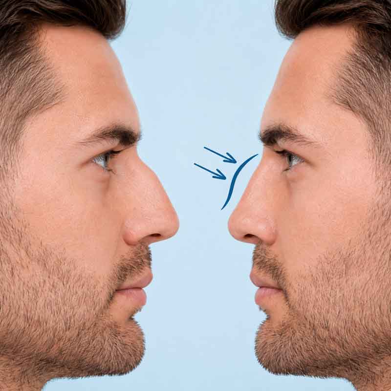 Rinoplastia-en-hombres