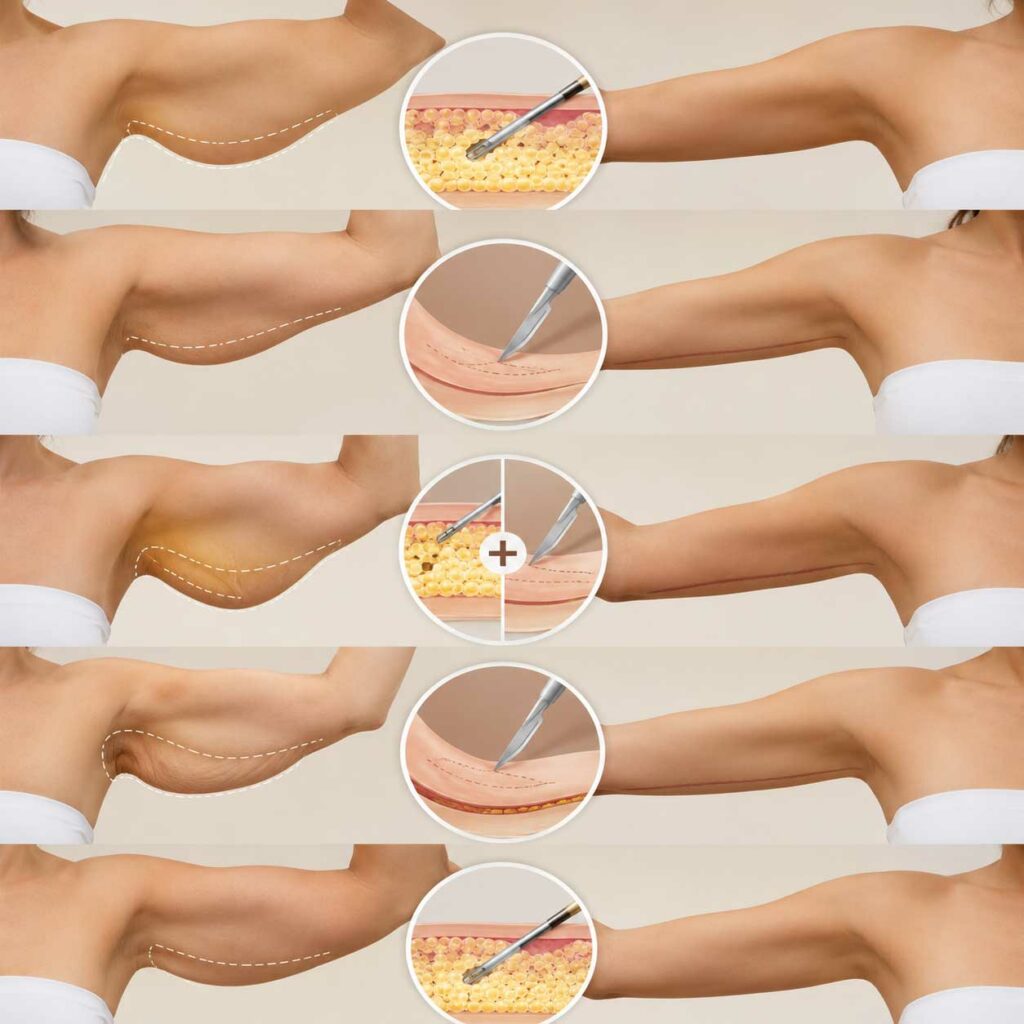 ¿Cuándo conviene una liposucción de brazos?