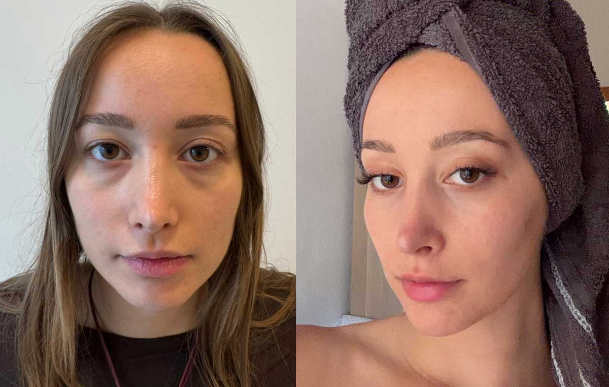 resultados de una blefaroplastia
